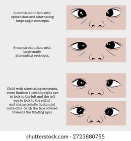 Amblyopia and strabismus: decreased visual acuity in one or both eyes.
