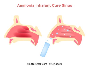 Ammonia Inhalant cure nasal cavity
