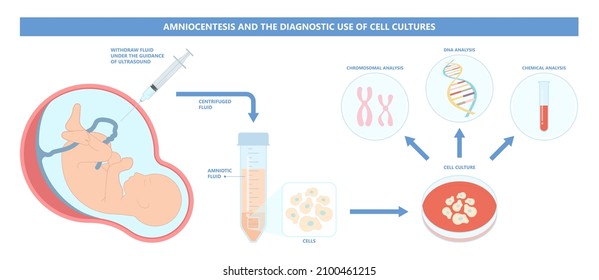 Amniocentesis Diagnostic Test Treat Lab Analysis Stock Vector (Royalty ...