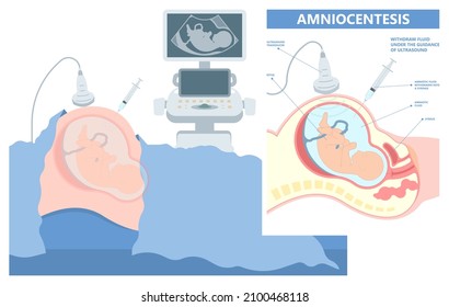 666 Amniocentesis Images, Stock Photos & Vectors | Shutterstock