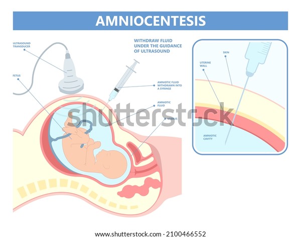 Amniocentesis diagnostic test treat LAB analysis\
DNA gene screen risk detect neural tube exam villus CVS check baby\
cell birth fetal sex down afp tay sachs spina alpha fetus loss\
cystic second\
fluid