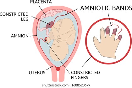 amniotic bands. fetus is entangled in fibrous string-like amniotic bands in the womb. Colored medical vector illustration. Fetus with umbilical cord and placenta.
