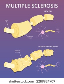 Amyotrophic lateral or demyelinating myelitis multiple sclerosis and Myasthenia Gravis systemic transverse Parkinson's disease of Guillain Barre Syndrome