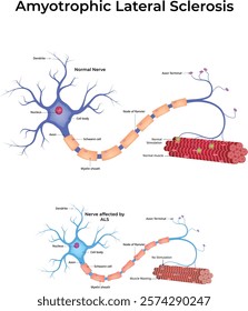 Amyotrophic Lateral Sclerosis (ALS) Design Vector Illustration