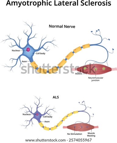 Amyotrophic Lateral Sclerosis (ALS) Design Vector Illustration
