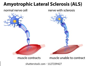 Amyotrophic lateral sclerosis concept illustration