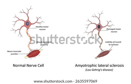 Amyotrophic lateral sclerosis(ALS) vector illustration