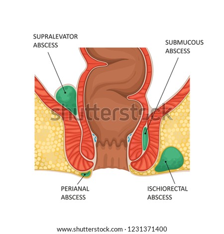 Anal abscess. Vector illustration