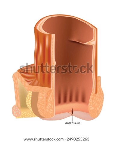 Anal fissure. Cross section rectum. Coloproctology surgery