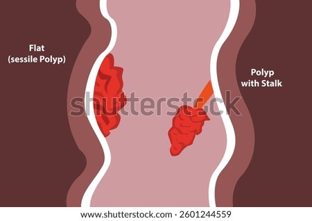 Anal Polyps cut away diagram. Editable Clip Art Vector