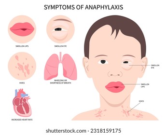 Anaphylaxis allergy Face swollen and bee sting the Epinephrine drug dose adrenaline of allergen nut syringe treat life threatening in septic heart failure