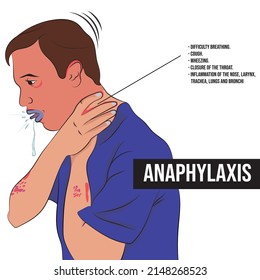 Anaphylaxis, an extremely severe allergic reaction that affects the entire body and sets in within minutes of being exposed to the allergen