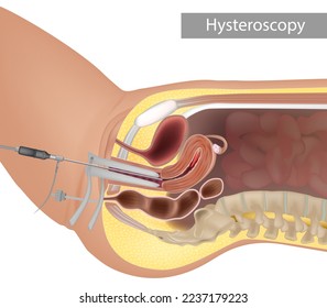 Ilustración anatómica de un procedimiento histeroscópico moderno. Inspección de la cavidad uterina mediante endoscopia. Procedimiento de histeroscopia