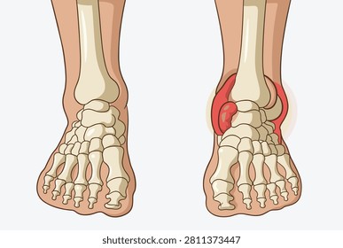 Anatomical comparison between a healthy foot skeletal structure and one showing soft tissue injury and inflammation around the ankle.