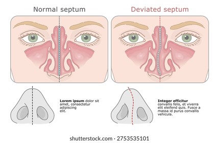 Anatomical comparison of a straight and deviated nasal septum in human nose. Vector illustration. ENT Series.