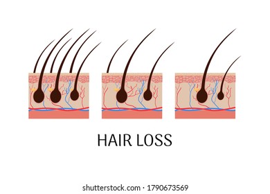 Anatomical concept hair loss stages, infographic isolated on white background stock vector illustration