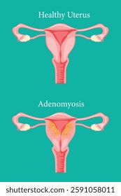 Anatomical diagram showing adenomyosis symptoms versus a healthy uterus. medical illustration. eps 10