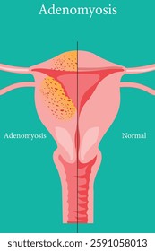 Anatomical diagram showing adenomyosis symptoms versus a healthy uterus. medical illustration. eps 10