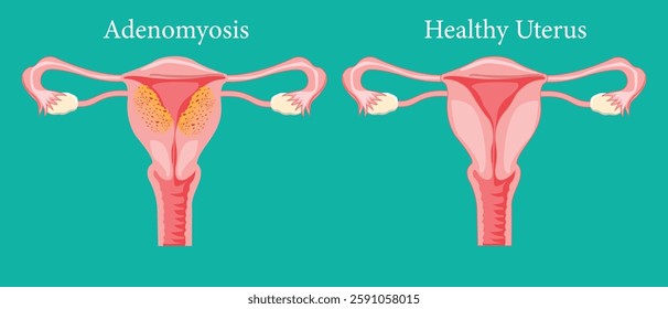 Anatomical diagram showing adenomyosis symptoms versus a healthy uterus. medical illustration. eps 10