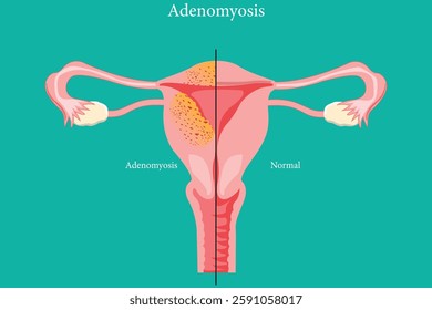 Anatomical diagram showing adenomyosis symptoms versus a healthy uterus. medical illustration. eps 10