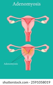 Anatomical diagram showing adenomyosis symptoms versus a healthy uterus. medical illustration. eps 10