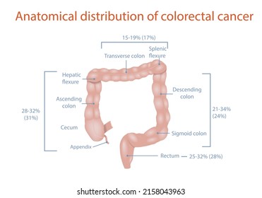 Anatomical Distribution Of Colorectal Cancer, Medical Diagram