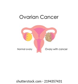 Anatomical Drawing. Ovarian Cancer. Women's Health.