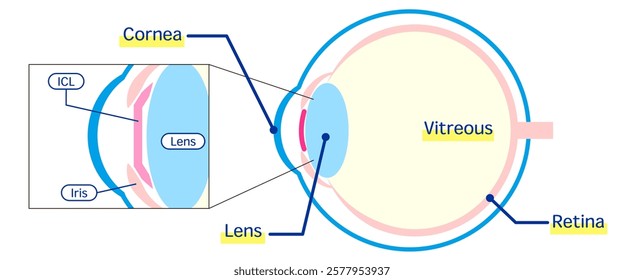 An anatomical illustration depicting the process of ICL (implantable contact lens) surgery. Ideal for educational or medical presentation materials about vision correction.