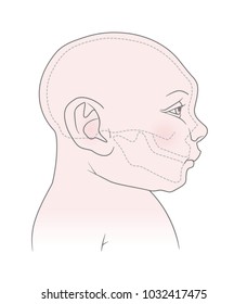 Anatomical image of the head and skull of a newborn child with microcephaly of the cranium. Virus Zika. Vector. Isolated on white background