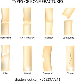Anatomical medical illustration showing various types of bone fractures, including transverse, comminuted, impacted, compound, spiral, greenstick, and fissure. 
