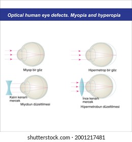 
Anatomische Struktur und Defekte der menschlichen Augen Augenkrankheiten und -störungen.