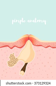 anatomical structure of a pimple. Vector illustration of human skin structure
