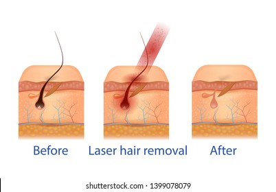 Anatomical Training Poster, Aid, Before and After Hair Removal Procedure. Anatomy Cross Section of Skin Layers. Red Laser Light Beam Damage Follicle. 3D Vector Realistic Illustration, Medical Banner