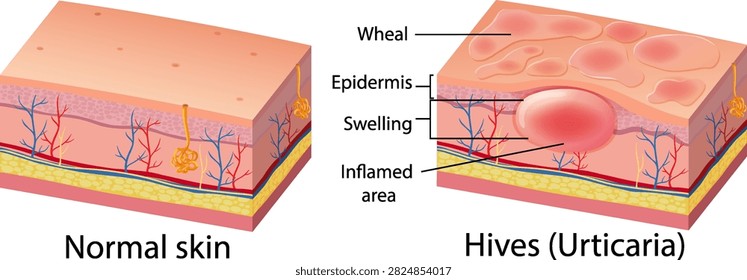 Anatomical vector illustration comparing healthy skin layers with hives, showing swelling, wheals, and inflammation.