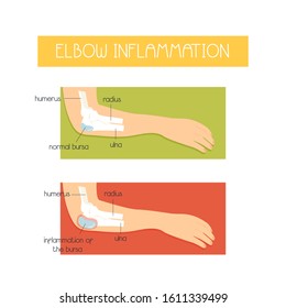 Anatomical vector illustration of elbow inflammation . Sport injuries concept