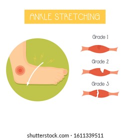 Anatomical vector illustration in a flat style of ankle stretching and its grades . Sport injuries