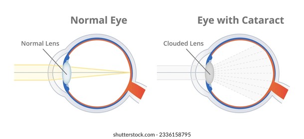 Esquema vectorial anatómico o ilustración de un ojo y ojo normal saludable con cataratas o cataratas aislados en blanco. Área nublada en la lente, nublando la lente. Trastorno de la visión ocular.