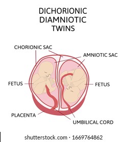 Anatomy of abdomen with twins.  infographic elements in flat design. diamniotic dichorionic Placentation of twins medical illustration and icon isolated on white background.