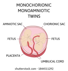 Monochorionic Images, Stock Photos & Vectors | Shutterstock