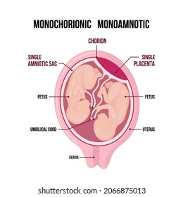 Anatomy of abdomen with twins. pregnancy type infographic elements in flat design. Monochorionic monoamniotic twins medical diagram isolated on white background.