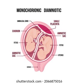 Anatomy of abdomen with twins. pregnancy type infographic elements in flat design. monochorionic diamniotic twins medical diagram isolated on white background.