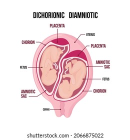 Anatomy of abdomen with twins. pregnancy type infographic elements in flat design. Dichorionic diamniotic twins medical diagram isolated on white background.