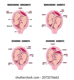 Anatomy of abdomen with twins. pregnancy types infographic elements in flat design. Monochorionic diamniotic twins medical diagram isolated on white background.