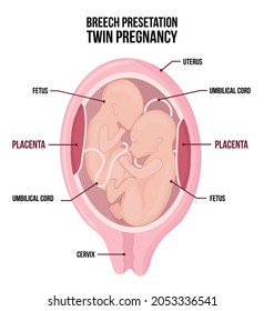 Anatomy of abdomen with twins. Pregnancy women diagram with breech presentation for both children. Head up position in womn. Vector medicine