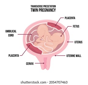 Anatomy of abdomen with twins. Pregnancy women diagrams with transverse presentation for one of children. Vector medicine