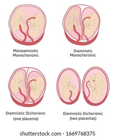 Anatomy of abdomen with twins. Twin types infographic elements in flat design. Monozygotic or Dizygotic Placentation of twins medical illustration and icons isolated on white background.