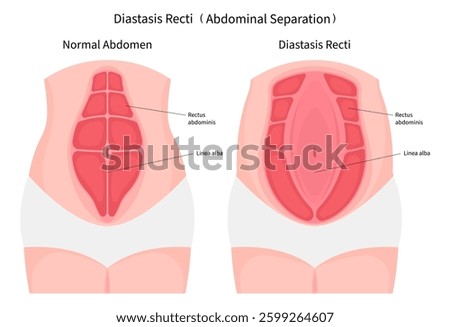 Anatomy of abdominal muscle separation after surgical which in medical called Diastasis Recti belly