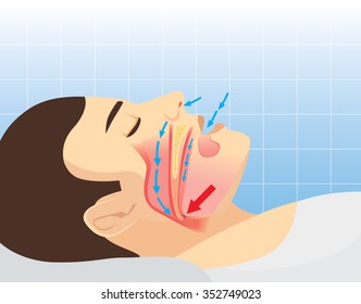 Anatomy about air way of man in sleeping and snoring. Illustration about health care and medical.