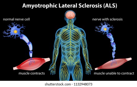 Anatomy of amyotrophic lateral sclerosis illustration