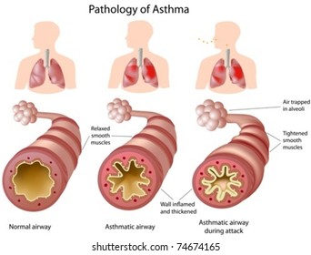 Anatomy of Asthma